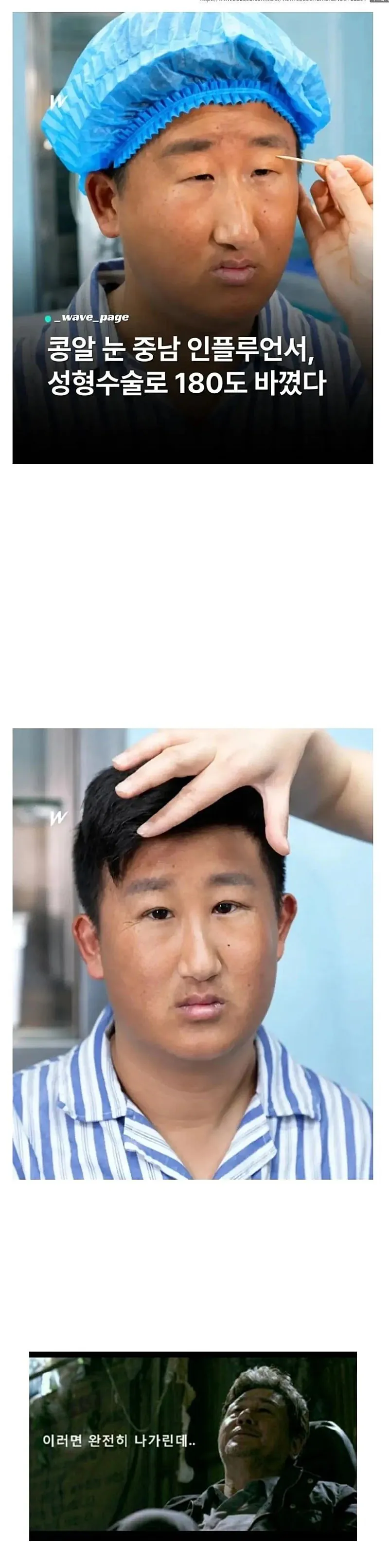 어느 인플루언서의 눈수술 후기.jpg